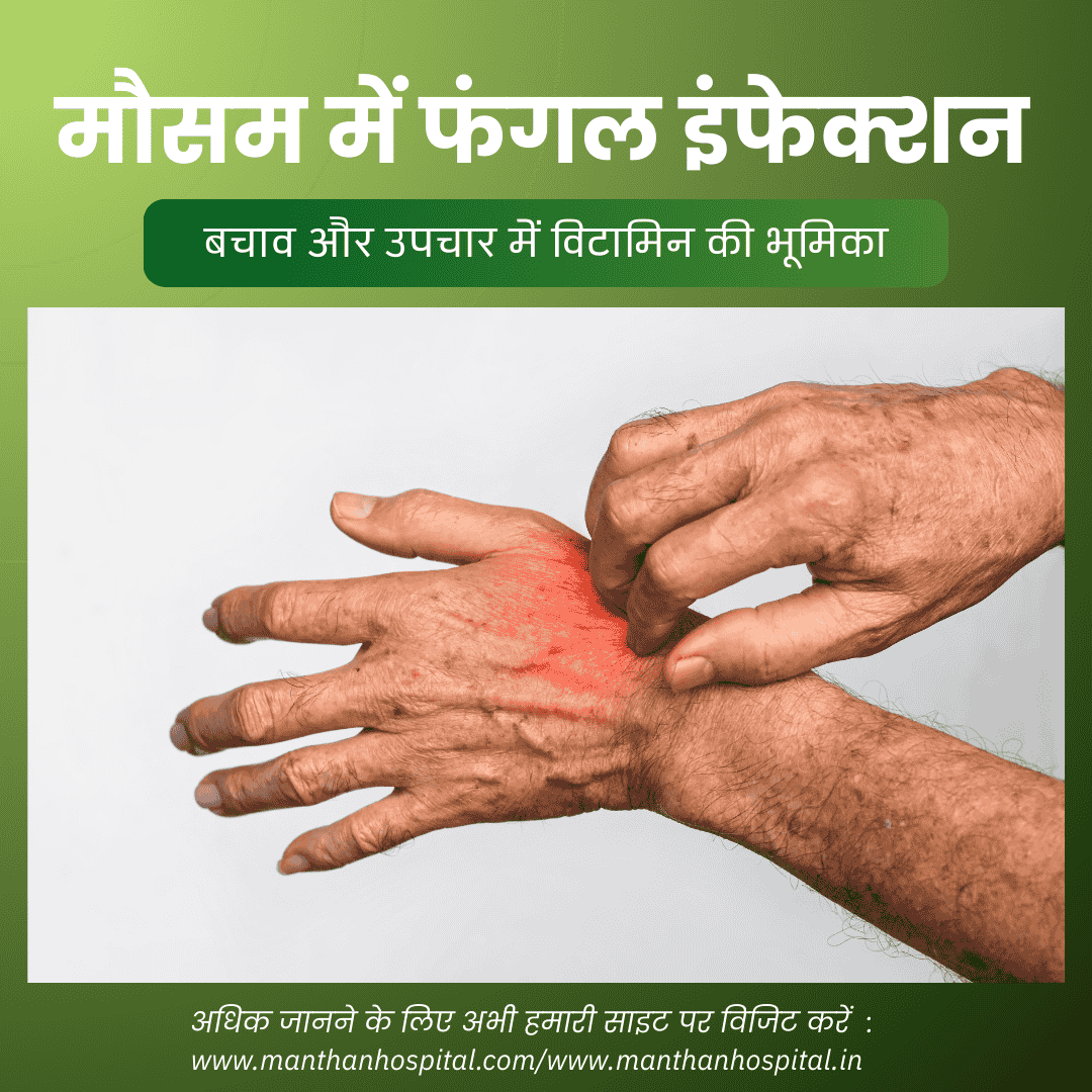 मौसम में फंगल इंफेक्शन : बचाव और उपचार में विटामिन की भूमिका